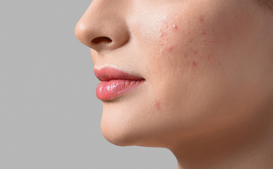 Jaki retinol na trądzik wybrać? Czy na pewno pomaga? ||