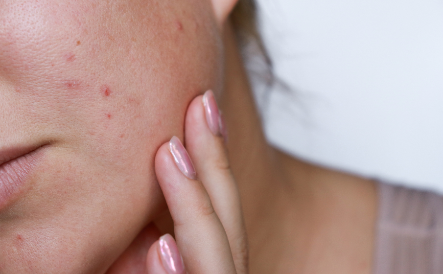 Pielęgnacja twarzy i skóry podczas kuracji izotretynoiną || jakie kosmetyki przy Izoteku można bezpiecznie używać?