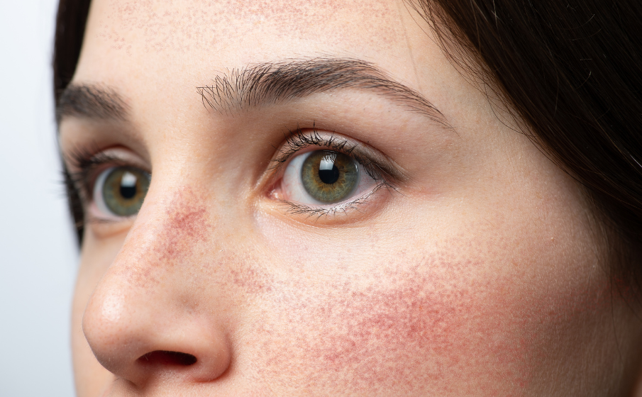 Dobry krem na naczynka i zaczerwienienia || ranking TOP10 najlepszych produktów